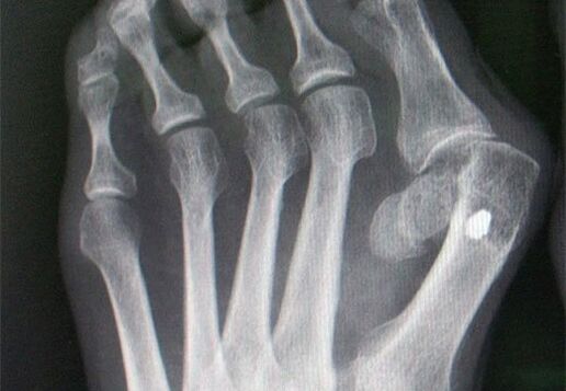 X -ray