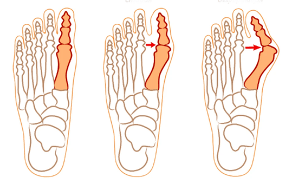 Hallux Valgus deformation