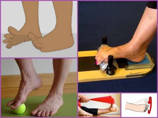 Exercise therapy for flat-valgus deformity of the foot