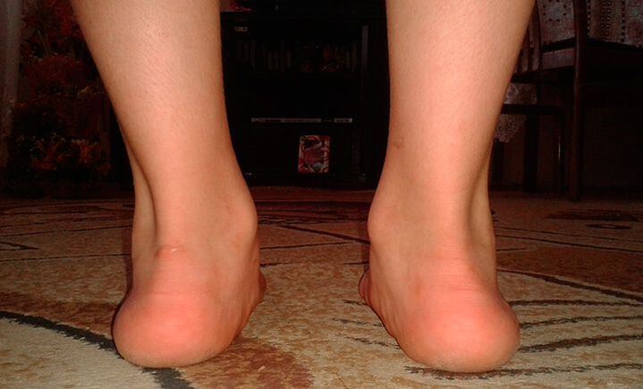 Flat valgus feet