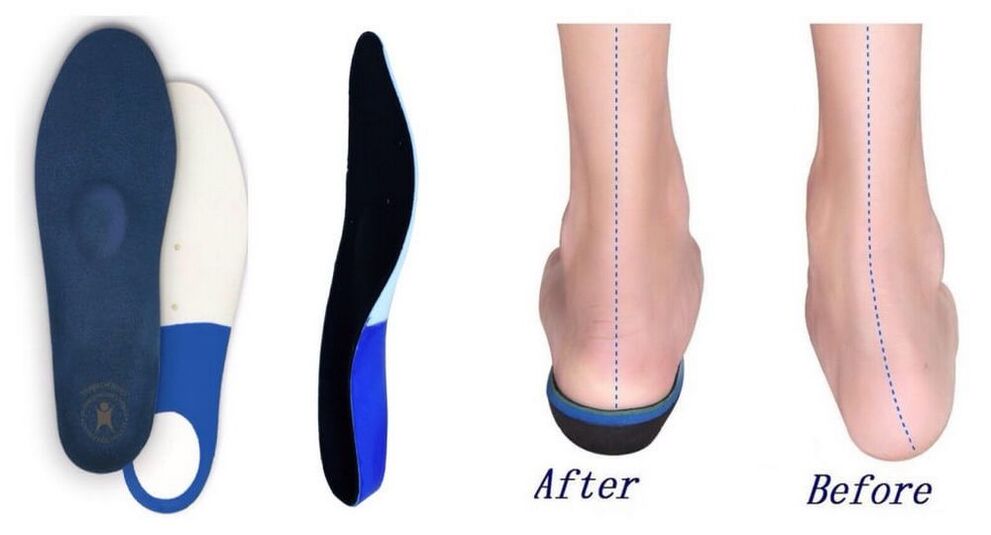 Orthopedic insoles for flat-valgus deformity of the foot
