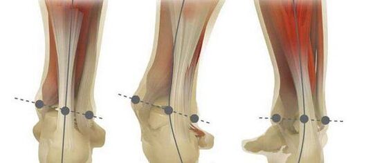 The norm of the axis of the foot and its curvature in plano-valgus deformity