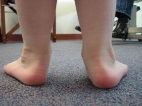 Flat valgus deformity of the foot in a child