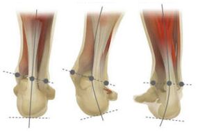 Normal foot, with valgus and varus deviation of the calteneus