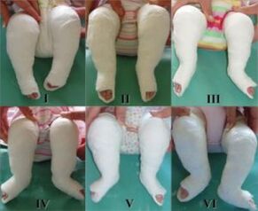 Plaster procedures, each of which changes the position of the foot