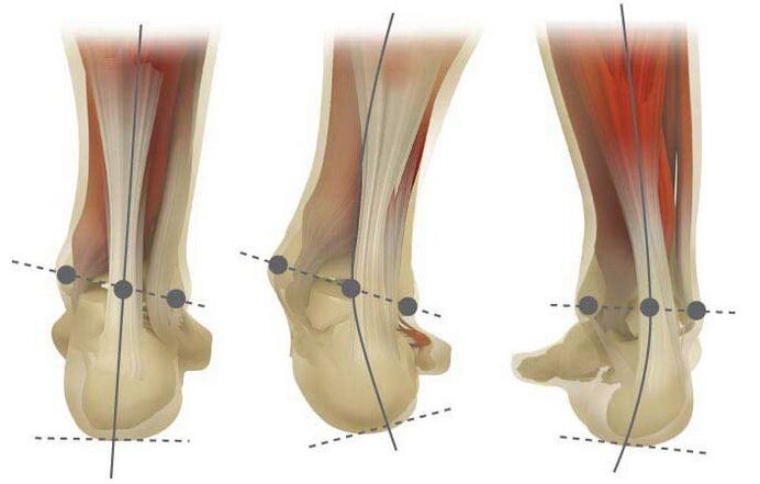 Valgus species