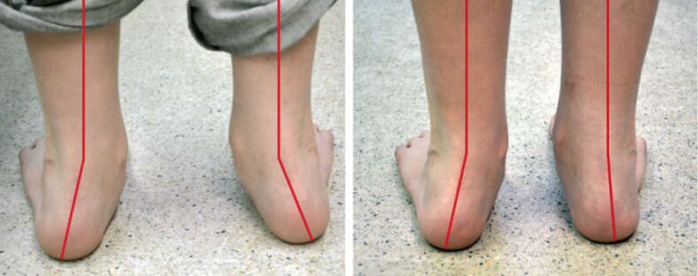 Valgus
