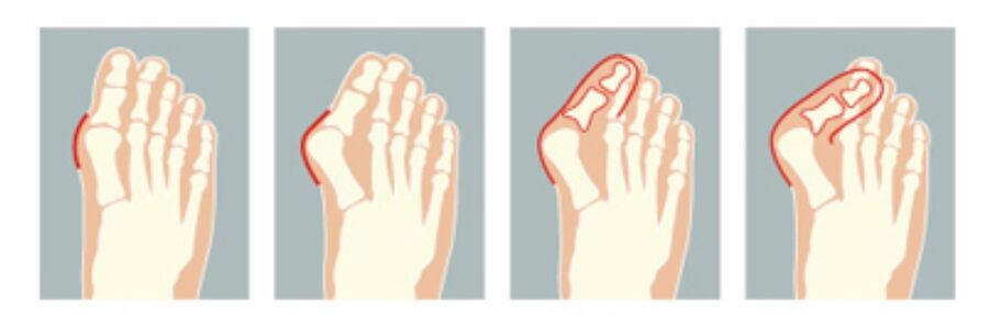deficiency