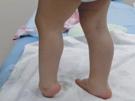 The first symptoms of valgus deformation on the foot