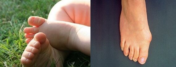 Valgus deformation of the first toe of the foot