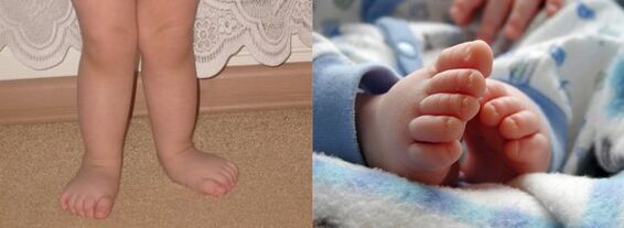Valgus deformation of the foot