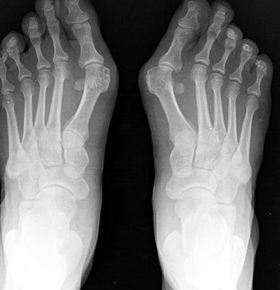 X -ray on the foot